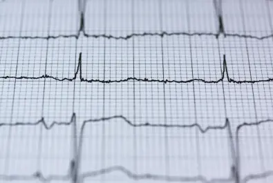 Elektrokardiyografi (EKG)